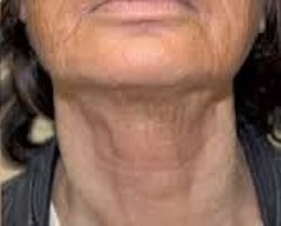 HIFU High intensity focused ultrasound treatment best skin clinic in chhindwara surat raipur nagpur bhopal