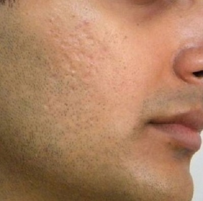 acne scar before after