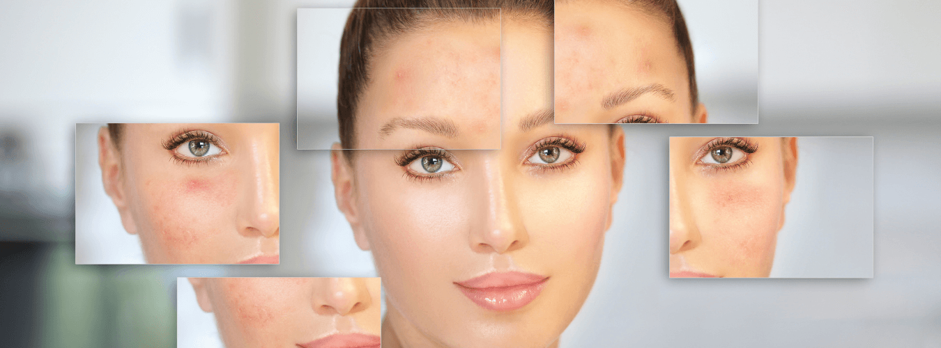acne scar removal treatment fungal infection dry lightening allergy whitening oily laser brightening best skin clinic in India