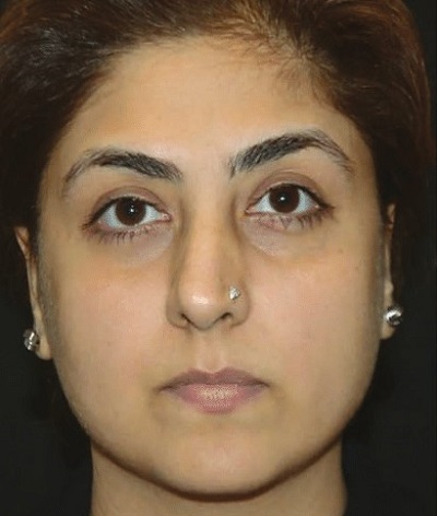 after eye brow lift treatment laser non surgical best dermatologists india ofy clinics before after