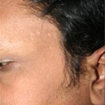 after mole removal treatment painless ofy skin clinics in surat chhindwara raipur nagpur bhopal india