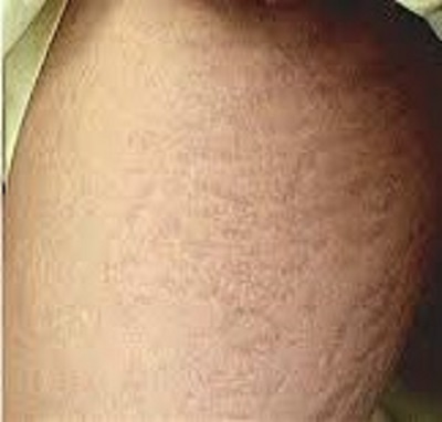 after stretch mark removal treatment skin treatment best dermatologists india ofy clinics