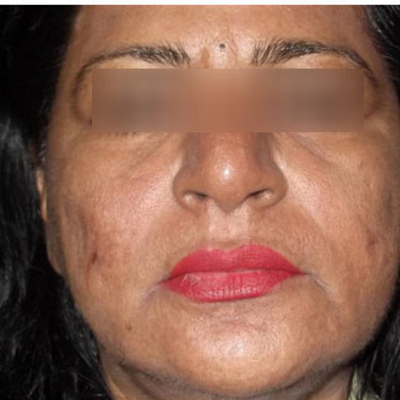 anti aging treatment best dermatologists wrinkles flawless skin ofy clinics chhindwara surat raipur bhopal nagpur.png