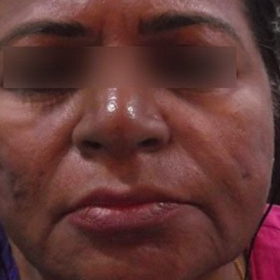 anti aging treatment best dermatologists wrinkles flawless skin ofy clinics