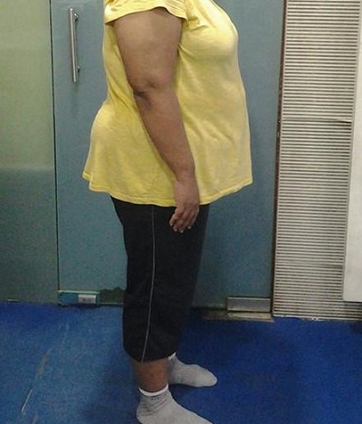 before obesity treatment slim fat loss ofy clinics dietician nutrionist india