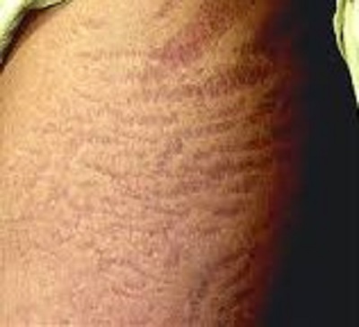 before stretch mark removal treatment skin treatment best dermatologists india ofy clinics