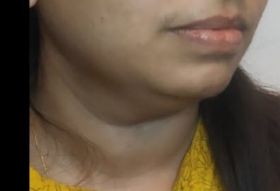 double chin reduction surgery before after ofy clinics bestdermatologists india nagpur chhindwara raipur bhopal indore reducer